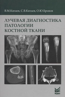 Лучевая диагностика патологии костной ткани. Китаев В.М., Китаев С.В., Бронов О.Ю.