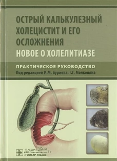 Острый калькулезный холецистит и его осложнения. Новое о холелитиазе